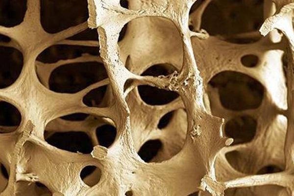 What You Need to Know About Osteoporosis