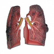 Cough Up A Lung Model, Best Seller, Award Winner, 1/each