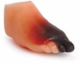 Sever Diabetic Foot Model , 1/each