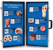 The Consequences of Diabetes 3DDisplay, 1/each