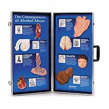 The Consequences of Alcohol Abuse 3-D Display, 1/each