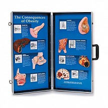 CONSEQUENCES OF OBESITY 3D DISPLAY Best Seller, 1/each